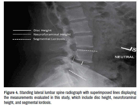 Cureus, Laterally Placed Expandable Interbody Spacers With and Without  Adjustable Lordosis Improve Radiographic and Clinical Outcomes: A Two-Year  Follow-Up Study