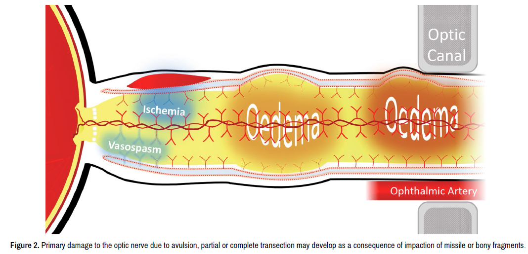 Trauma treatment optic nerve